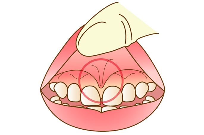 唇小帯手術